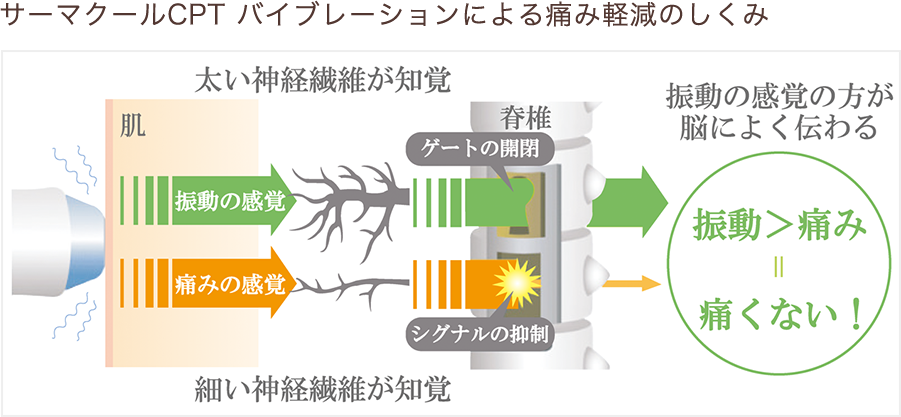 サーマクールCPT バイブレーションによる痛み軽減のしくみ