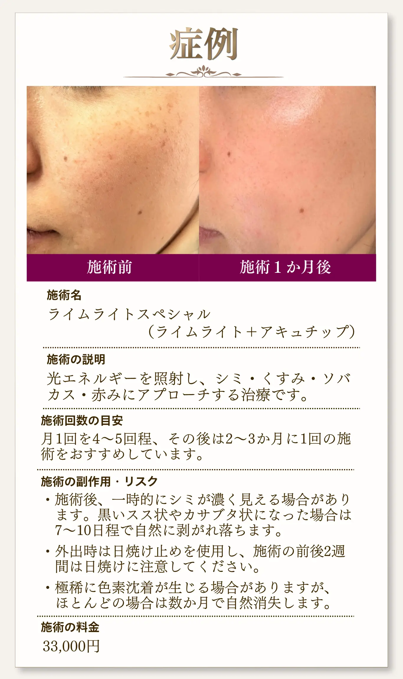 シミ・くすみ治療の症例。施術前と施術1か月後の比較で肌のトーンが改善した事例。ライムライトスペシャルの説明、回数目安、副作用、料金33000円の案内