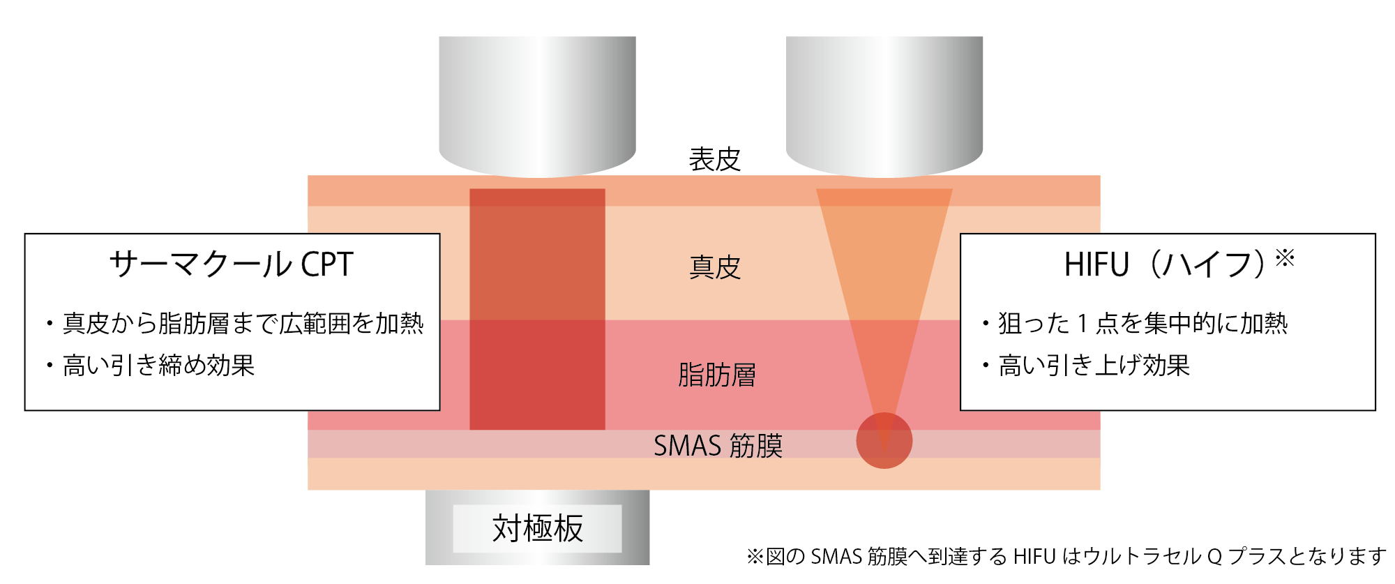 サーマクールとHIFU（ハイフ）の違い②.png