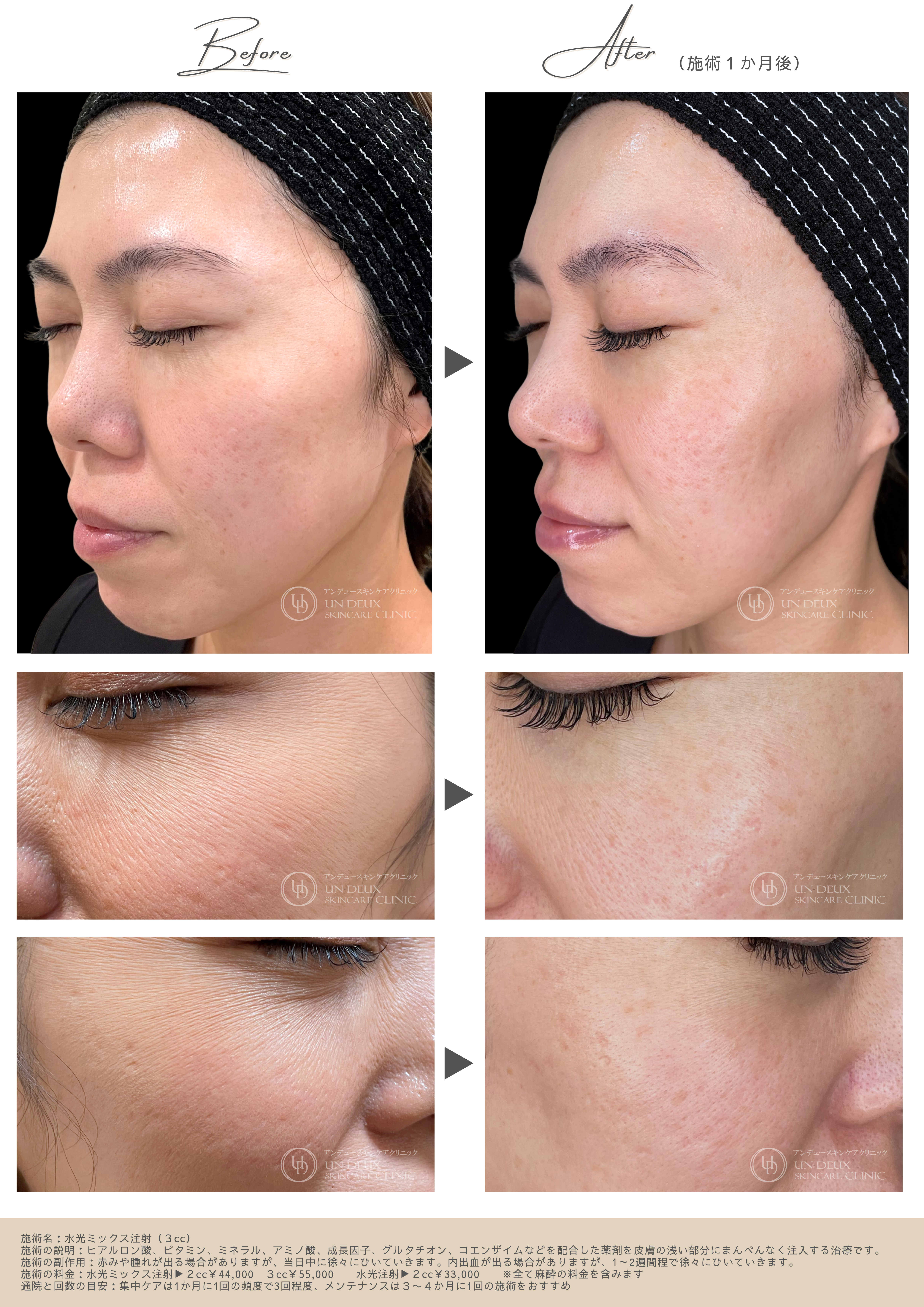 水光注射症例ビフォーアフター.png