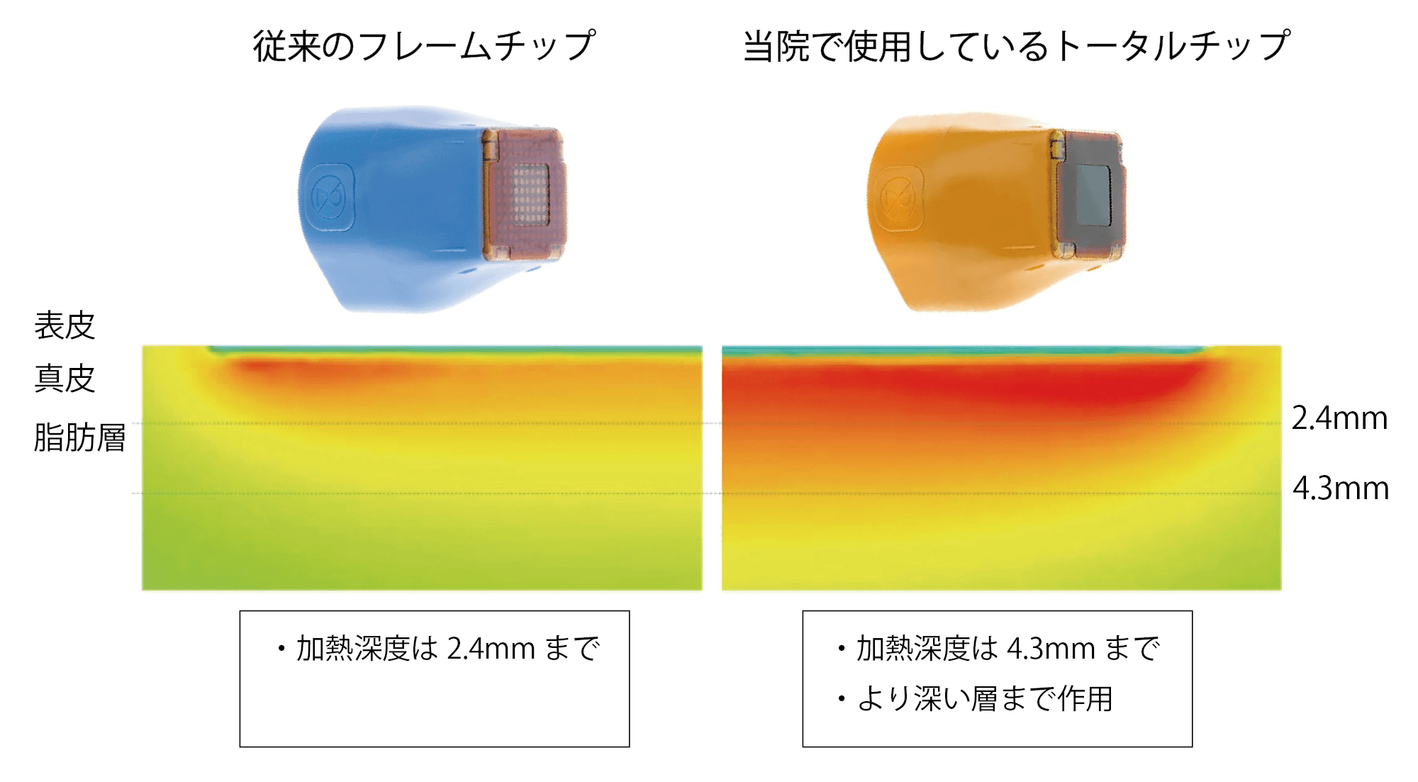 フレームチップとトータルチップの違い.png