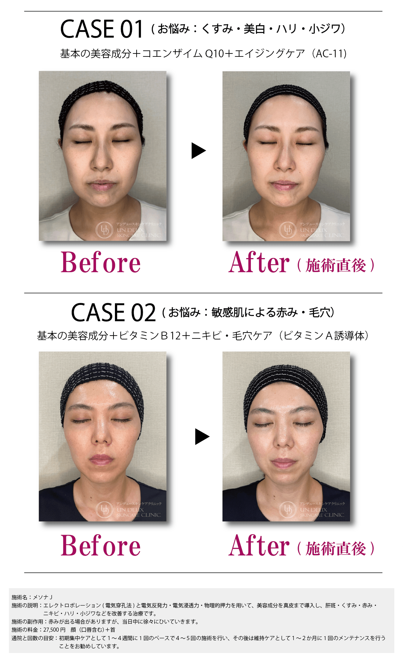 メソナＪビフォーアフター写真.png