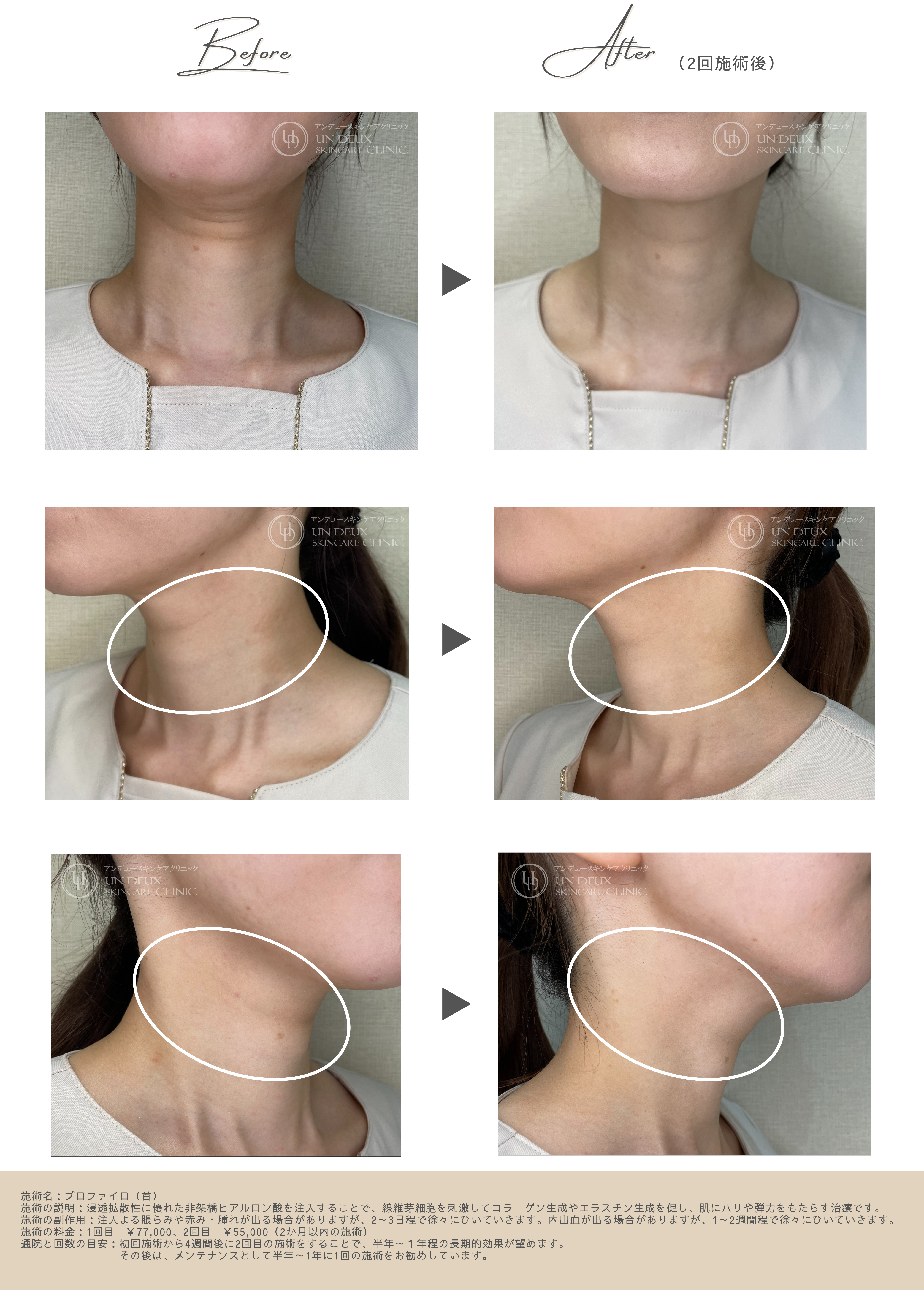 プロファイロ首症例ビフォーアフター.png