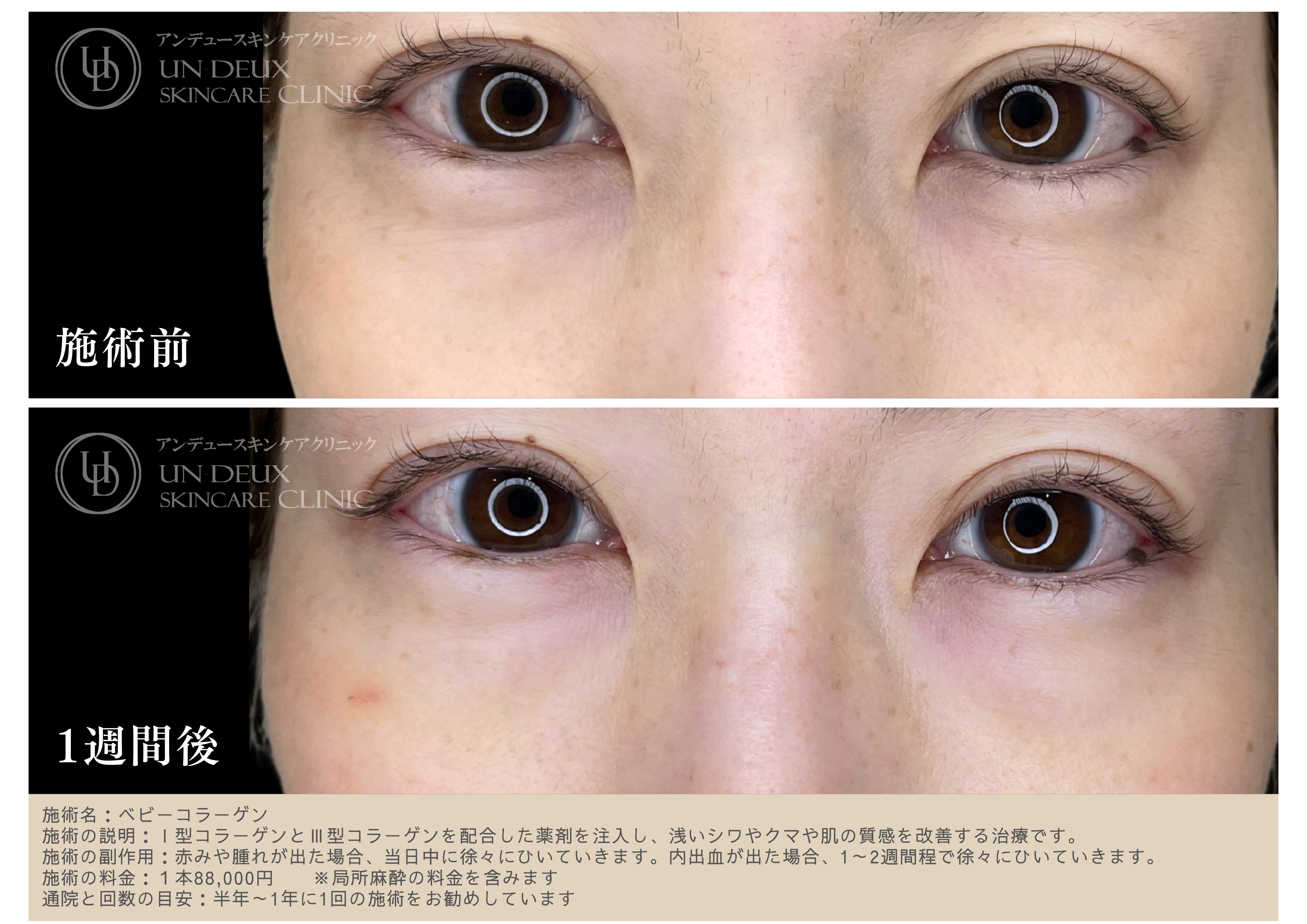 ベビーコラーゲン症例②.png