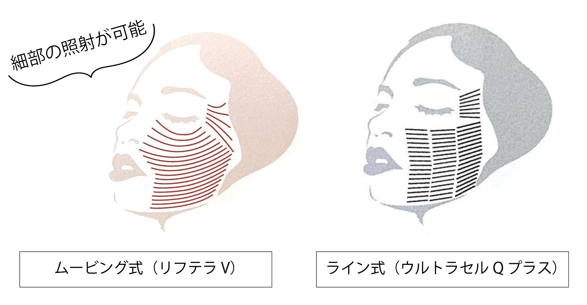 ムービング式とライン式の違い.png