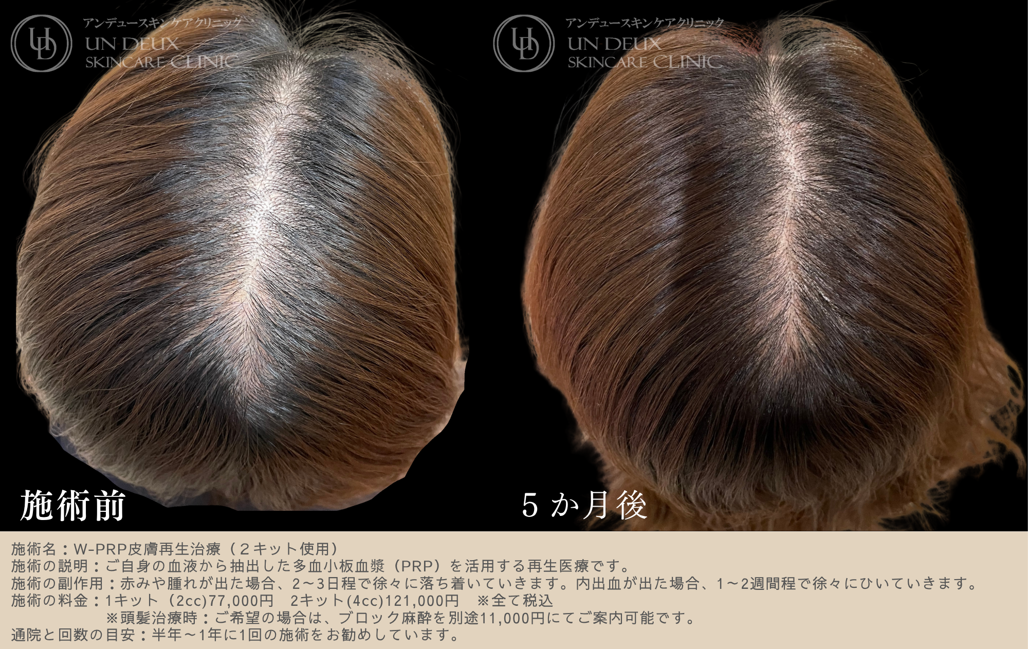 ブログ用W-PRP皮膚再生治療顔 ③.png