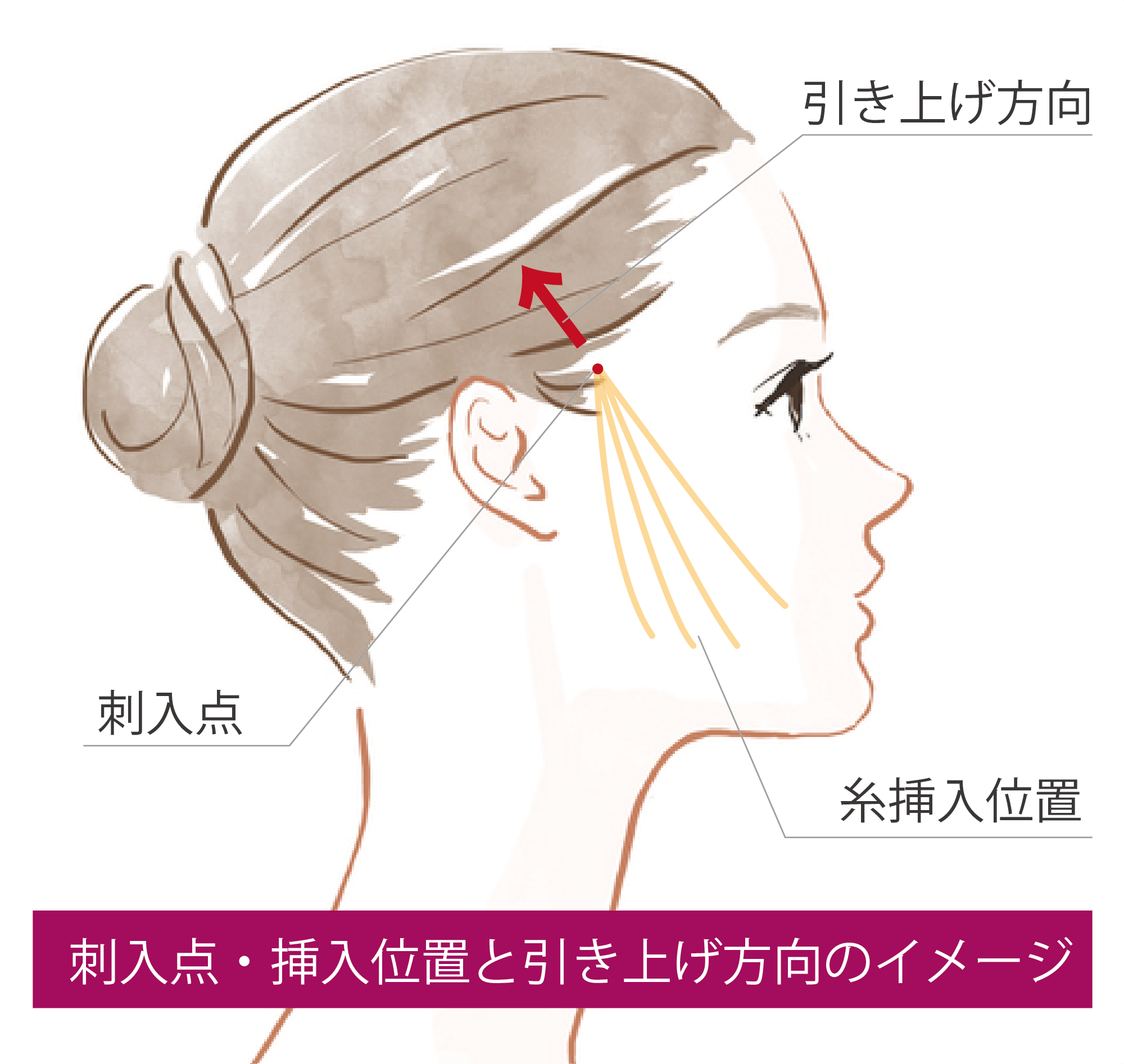 糸リフトの刺入点・挿入位置と引き上げ方向のイメージ.png